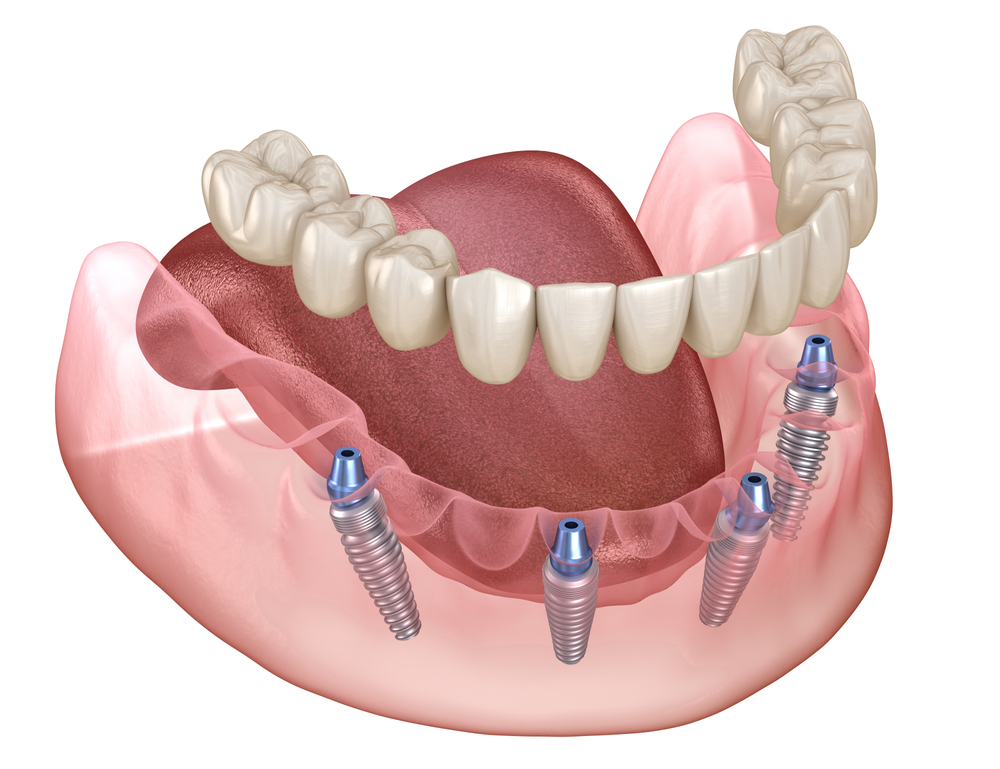 all-on-4 dental implant