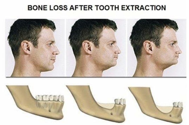 bone loss