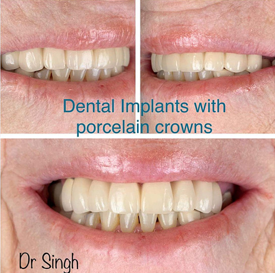 Implant Dental in 11967