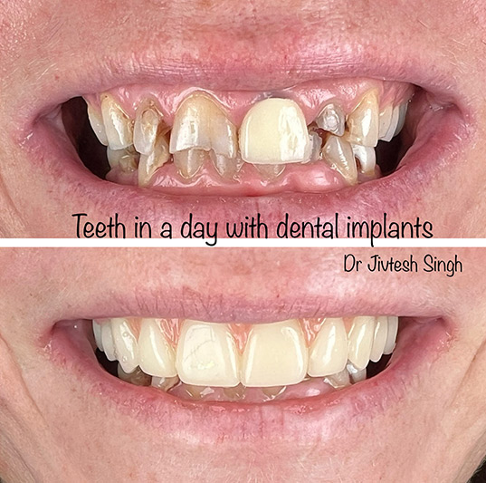 Implant Dental in 11967