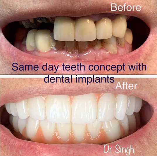 Dental Implants in NY