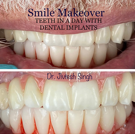 Implant Dental in 11967