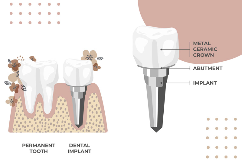 teeth in a day