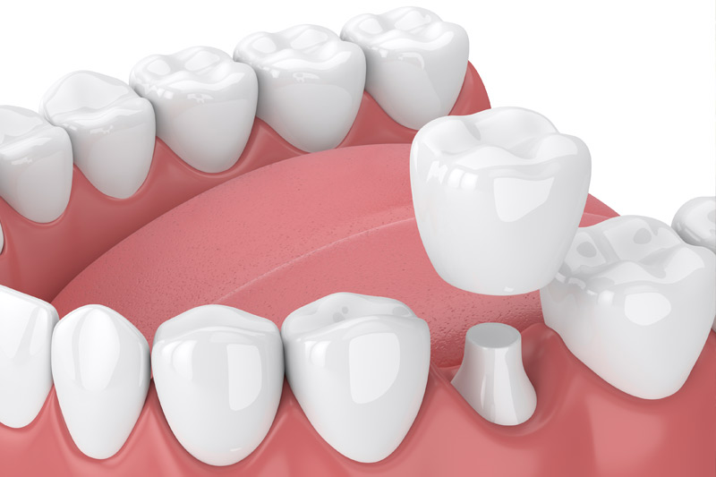 Dental Crowns in Shirley