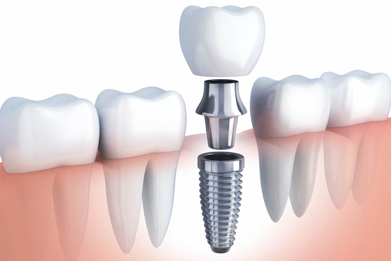 Implants Dentist in Shirley