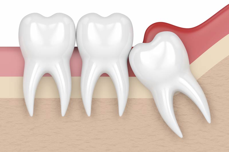 Wisdom Tooth Removal in Shirley